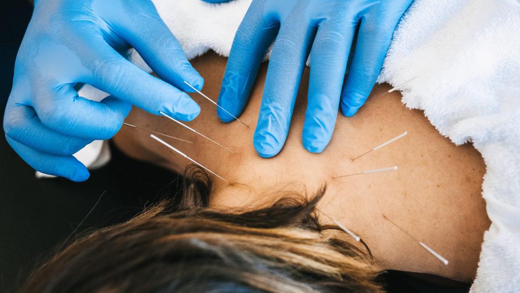 Is dry needling right for you?