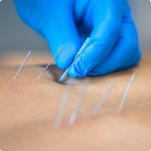 Dry Needling Image